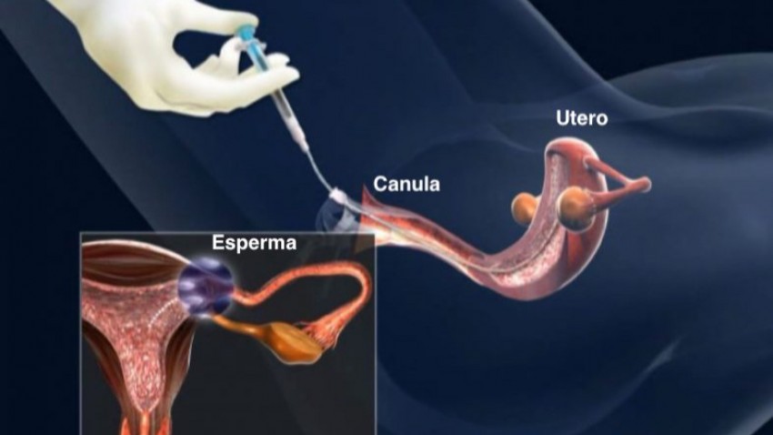 Inseminación artificial ¿qué es?