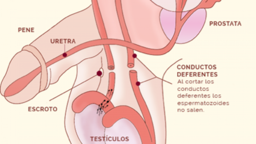 Reversión de la vasectomía si es posible